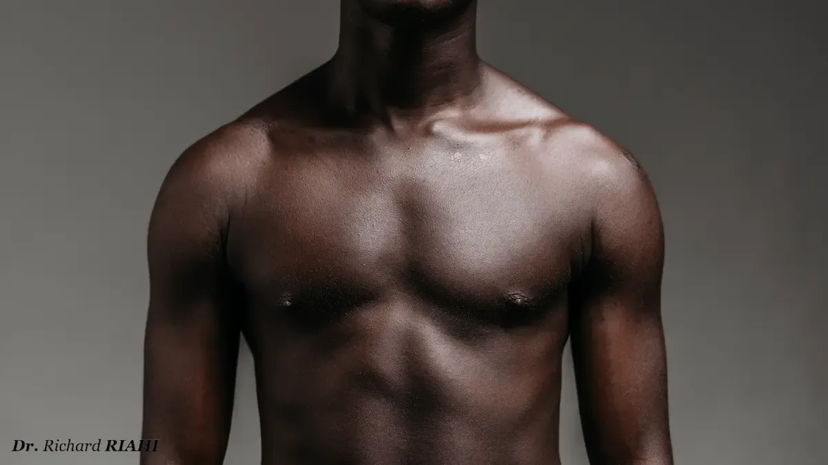 Gynécomastie : Accroissement du volume de la glande mammaire chez l’homme