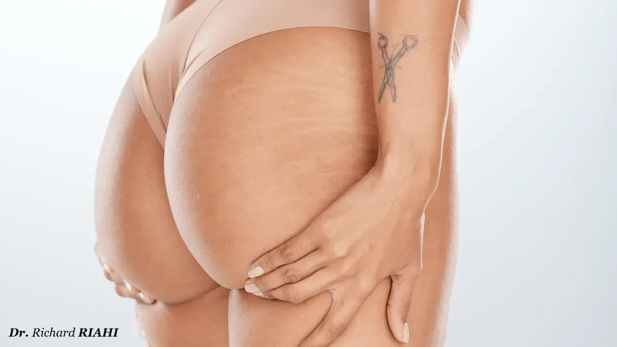 Implants fessiers